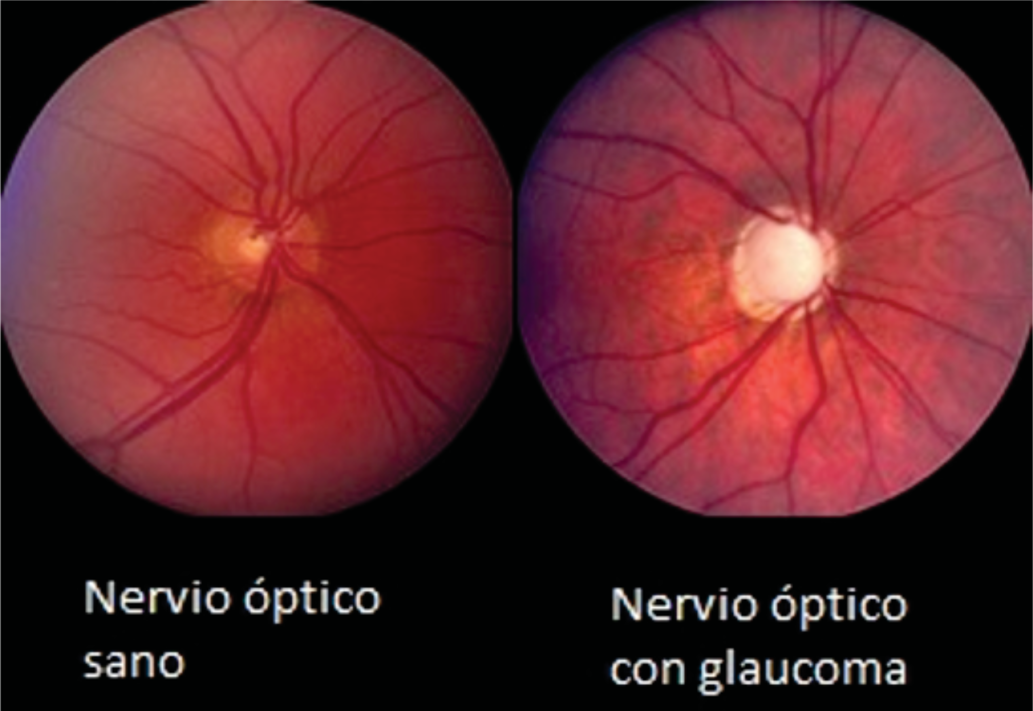 Deep learning' para la detección precoz del glaucoma | Fundación Seneca